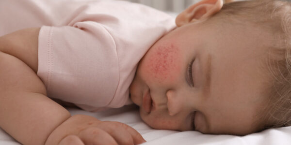 Atopik Dermatit Nedir?